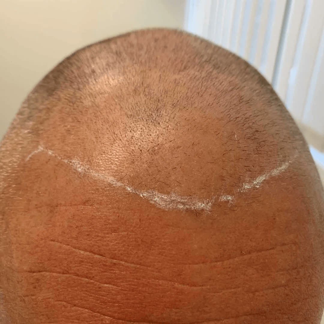 Close-up of a treated crown showing graft placement